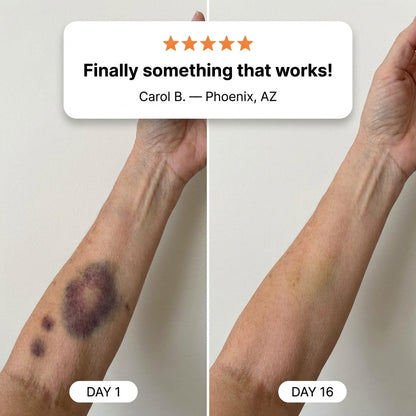 💥100K+ SOLD💕-  Bruise Repair & Skin-Strengthening Cream